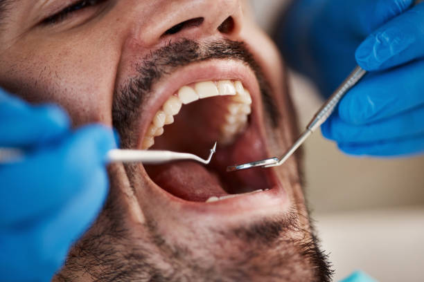 Best Emergency Wisdom Teeth Removal in Wona Lake, IN